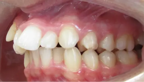 Side view before treatment, with the overjet visible from the opposite side.