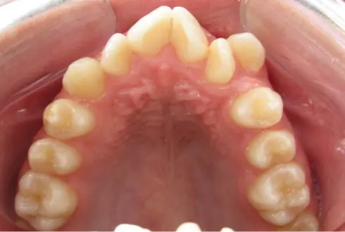 Top-down view of the upper teeth before treatment, showing crowding and a narrow arch.