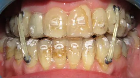 Front view mid-treatment, with elastics fitted to coordinate the arches.