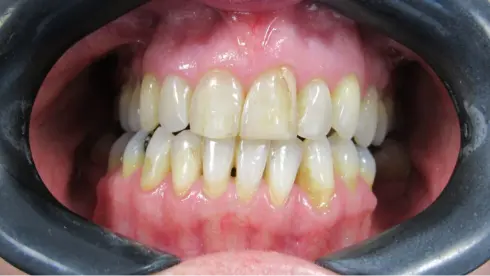 Front view at a later stage, showing the teeth coming into alignment.