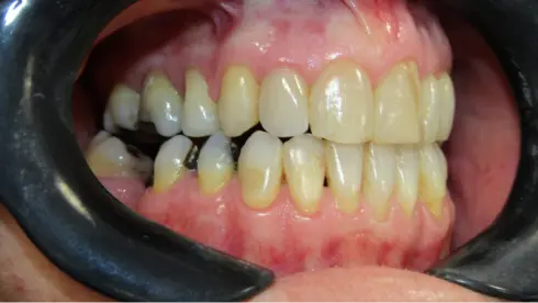 Side view at a later stage, showing improved bite alignment.