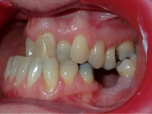 Side view during treatment, showing the bite beginning to correct.