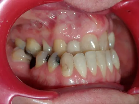 Side view before treatment, showing crossbite and crowding in an older adult patient.