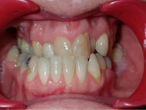 Front view before treatment, showing severe crowding and crossbite.