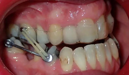 Side view during early treatment, with the appliance and elastics fitted.