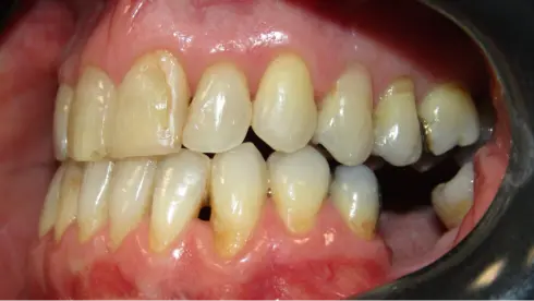 Side view of final result, showing corrected crossbite and stable alignment.