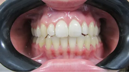 Front view of final result, showing closed bite and aligned smile.