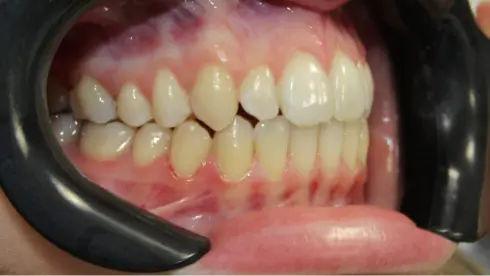 Side view of final result, showing corrected bite and proper alignment.