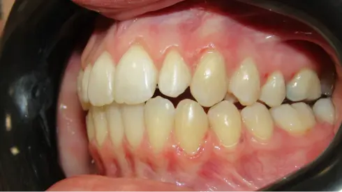 Side view after treatment, showing fully corrected bite and stable alignment.