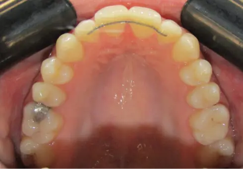 Top-down view of the lower teeth after treatment, evenly aligned with retainer fitted.