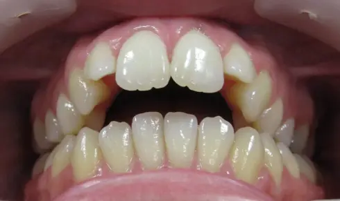 Front view before treatment, showing the open bite between upper and lower teeth.