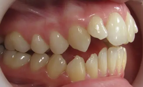 Side view of patient's teeth before treatment, showing overjet and crowding.