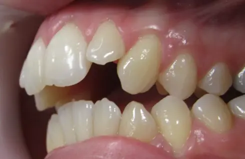 Side view during treatment, with open bite still visible in the early phase.