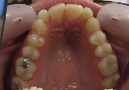 Top-down view of the upper teeth after treatment, showing a well-aligned arch.