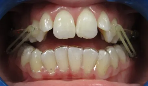Front view mid-treatment, with buttons and elastics fitted to help close the open bite.