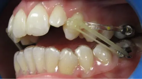 Side view with elastics fitted on the appliance, working to close the open bite.