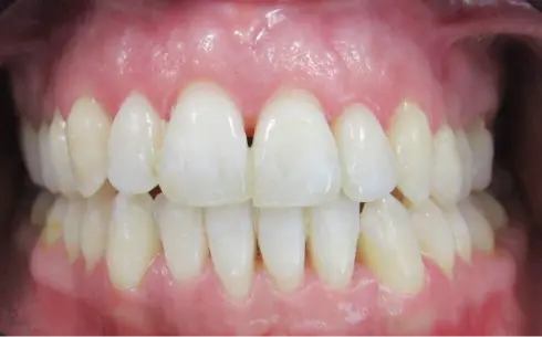Same front view after treatment - teeth evenly aligned and midline corrected.