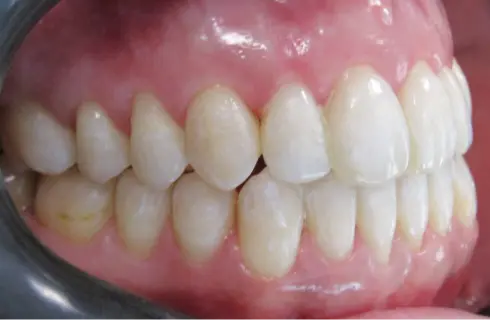 Same side view after treatment - bite corrected and teeth properly aligned.