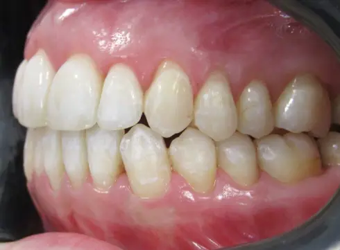 Same view after treatment - bite balanced and teeth meeting correctly.