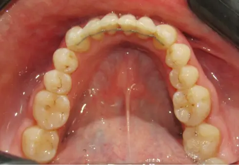 Same view of the lower teeth after treatment - fully aligned with the lower retainer fitted.