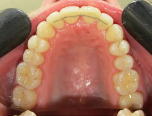 Same view of the upper teeth after treatment - broader arch and even spacing.