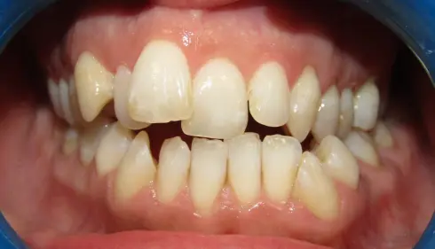 Front view of patient's teeth before treatment, with visible crowding and shifted midline.
