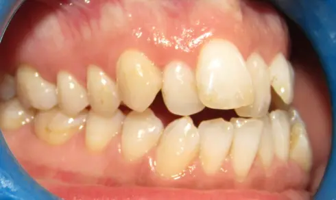 Side view of patient's teeth before treatment, showing crossbite and misalignment.
