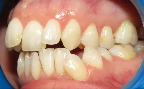 Opposite side view before treatment, showing the bite issue from the other angle.