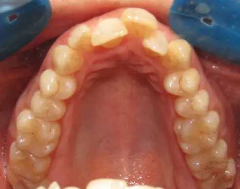 Top-down view of the upper teeth before treatment, showing narrow arch and crowding.