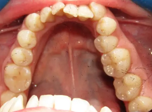 Top-down view of the lower teeth before treatment, with crowding and uneven alignment.