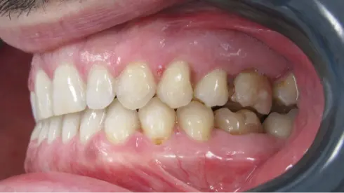 After treatment - restored adult smile at Ocean Orthodontics Edinburgh, no extractions.