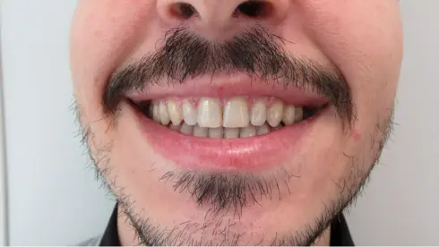Same patient smiling after treatment at Ocean Orthodontics -  gap closed, natural result.