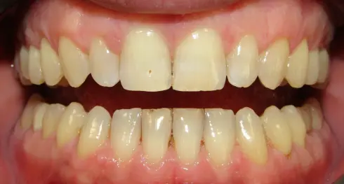 After orthodontic treatment - aligned upper and lower teeth with spaces fully closed.