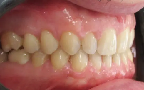 After treatment - right side view showing closed spacing and aligned bite, Edinburgh.
