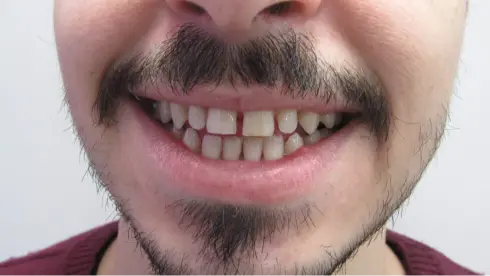 Patient's smile before orthodontic treatment, showing a gap between the front teeth.