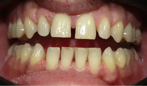Before orthodontic treatment - front view of adult patient with generalized spacing.