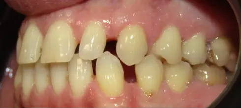 Before treatment, close-up of adult dental arches before spacing correction in Leith.